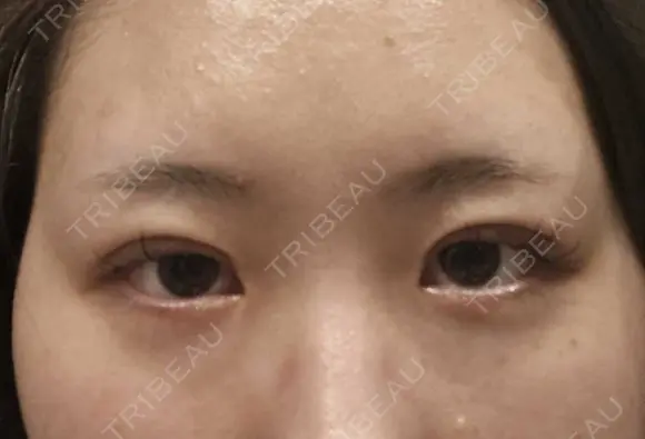 二重埋没 HAAB×DREAM BEAUTY CLINIC 大阪梅田院 DAY 0 メイン用
