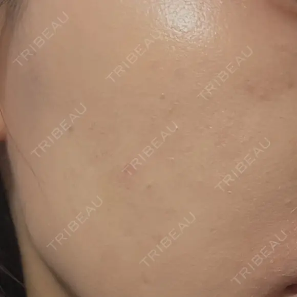 肌育注射（ジュベルックなど） Natural Skin Clinic 自由ヶ丘院 AFTER メイン用