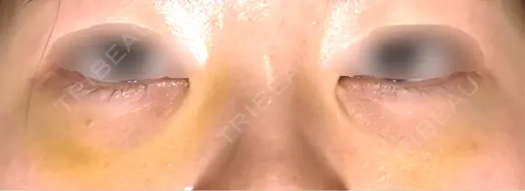 下まぶたの脂肪取り APOLLO BEAUTY CLINIC DAY 9 メイン用
