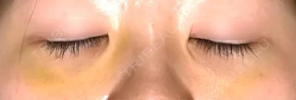 下まぶたの脂肪取り APOLLO BEAUTY CLINIC DAY 9 メイン用