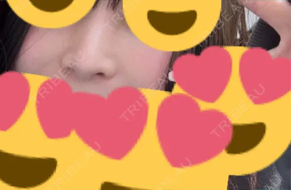 小鼻縮小（切開） アネシス美容クリニック DAY 23 メイン用