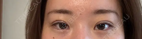 二重埋没 東京シンデレラ美容外科 池袋院 AFTER メイン用