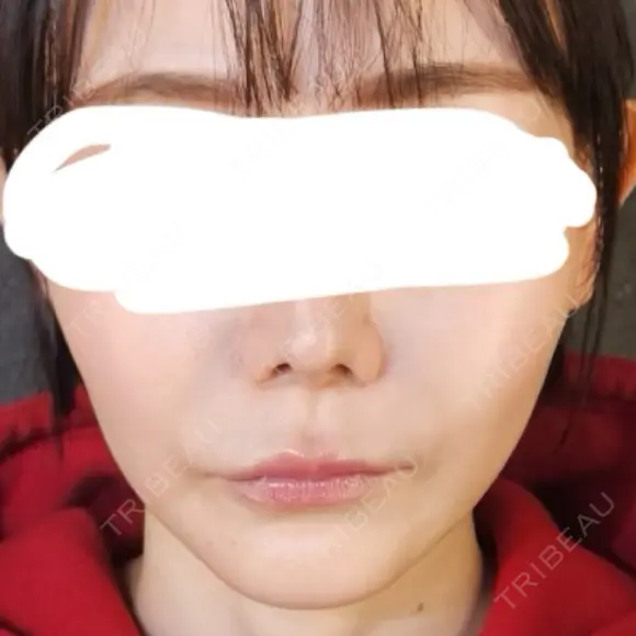糸リフト / 目尻切開 / タレ目形成・グラマラスライン（切開） / ボトックス（あご） / ヒアルロン酸注入（あご） / ヒアルロン酸注入（鼻翼基部） Tokyo Tensei Clinic 新宿院 DAY 44 メイン用