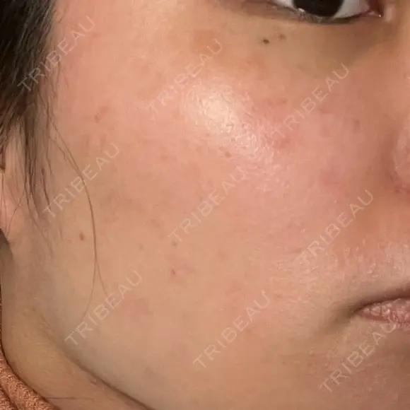 光治療（フォトフェイシャルなど） 81clinic DAY 9 メイン用