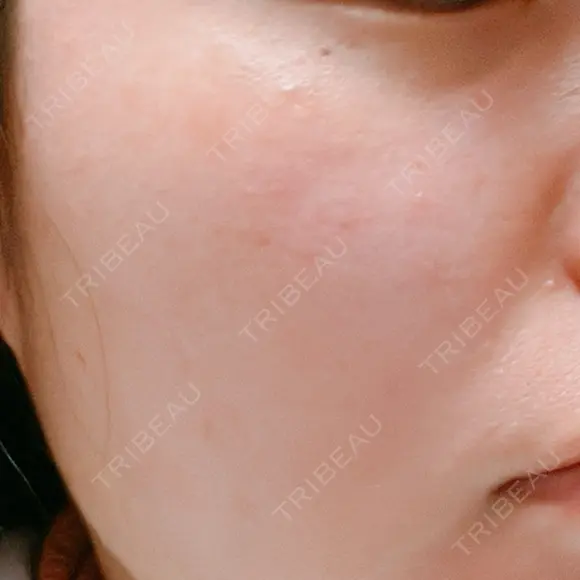 光治療（フォトフェイシャルなど） 81clinic DAY 10 メイン用