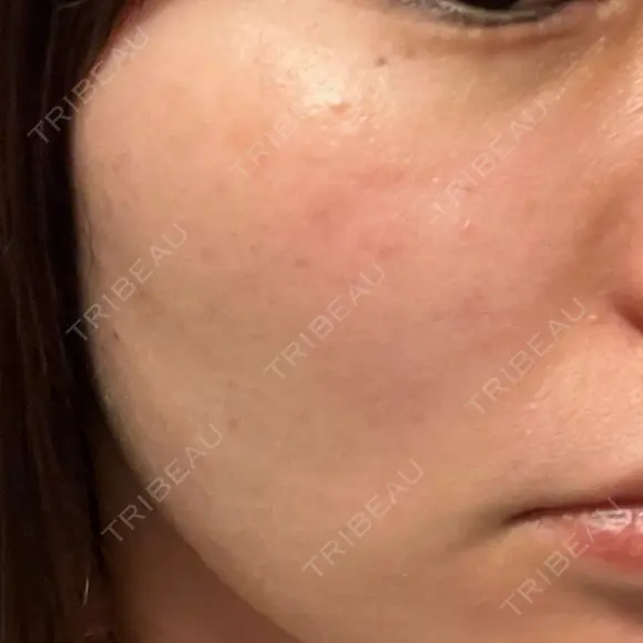 光治療（フォトフェイシャルなど） 81clinic DAY 11 メイン用