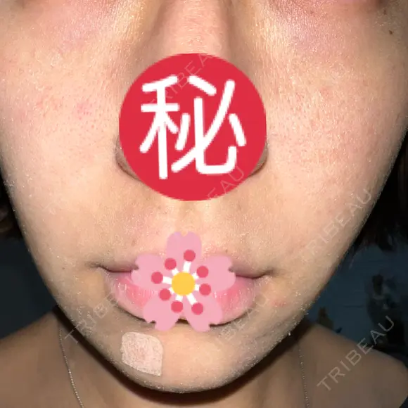 ヴェルヴェットスキン ゆう美容クリニック DAY 4 メイン用