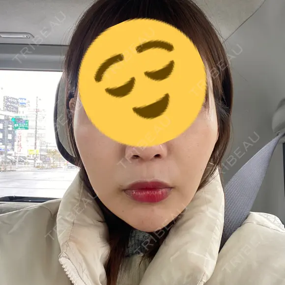 ハイフ（顔） 表参道メディカルクリニック 新宿院 DAY 2 メイン用