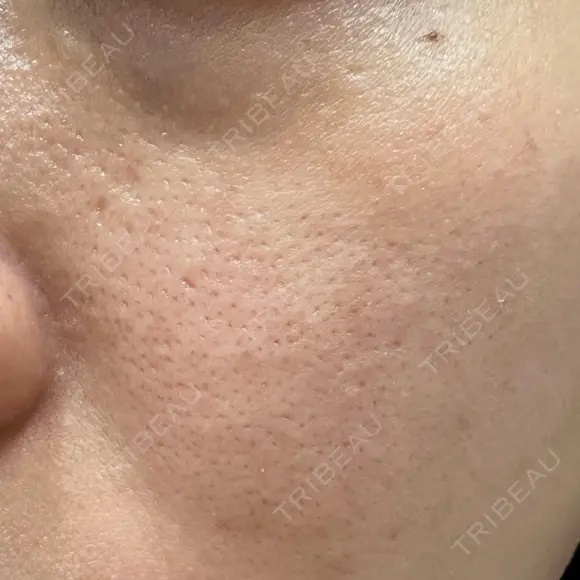 ヴェルヴェットスキン ゆう美容クリニック DAY 5 メイン用