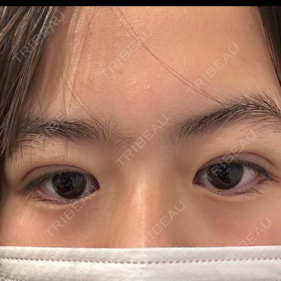 二重埋没 湘南美容クリニック 千葉センシティ院 DAY 0 メイン用