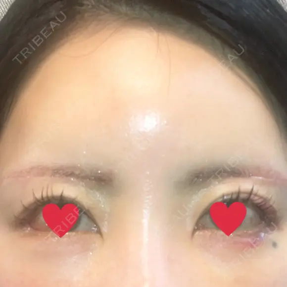 タレ目形成・グラマラスライン（切開） ルラ美容クリニック 渋谷本院 DAY 3 メイン用