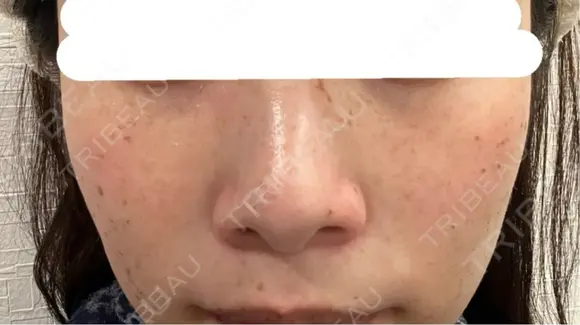 ピコスポット 博多もへじのクリニック DAY 7 メイン用