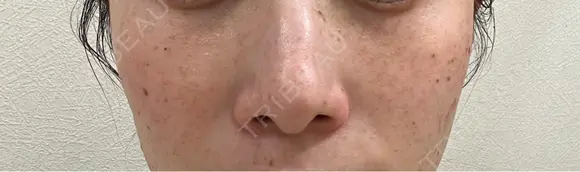 ピコスポット 博多もへじのクリニック DAY 6 メイン用