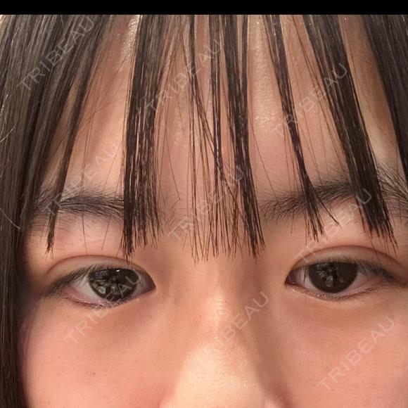 二重埋没 湘南美容クリニック 千葉センシティ院 DAY 1 メイン用