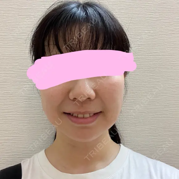 メーラーファット除去 WOM CLINIC GINZA （ワム クリニック ギンザ） AFTER メイン用