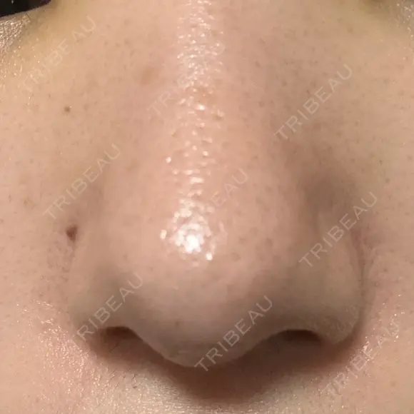 鼻尖形成（切開） / 小鼻縮小（切開） / その他（鼻） 東京形成美容外科 船橋院 AFTER メイン用