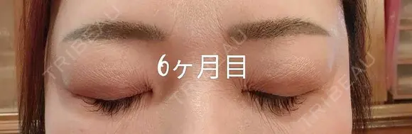 目元修正 / 自然癒着法 LUHO（ルホ）美容外科 AFTER メイン用