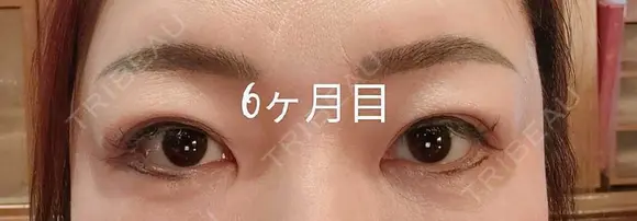 目元修正 / 自然癒着法 LUHO（ルホ）美容外科 DAY 188 メイン用