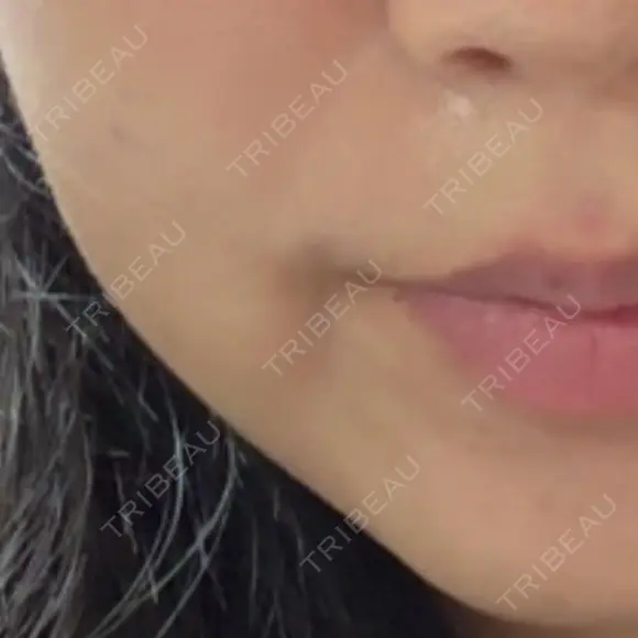 ボトックス（あご） / ボトックス（エラ・小顔） Zetith Beauty Clinic 福岡院 DAY 2 メイン用