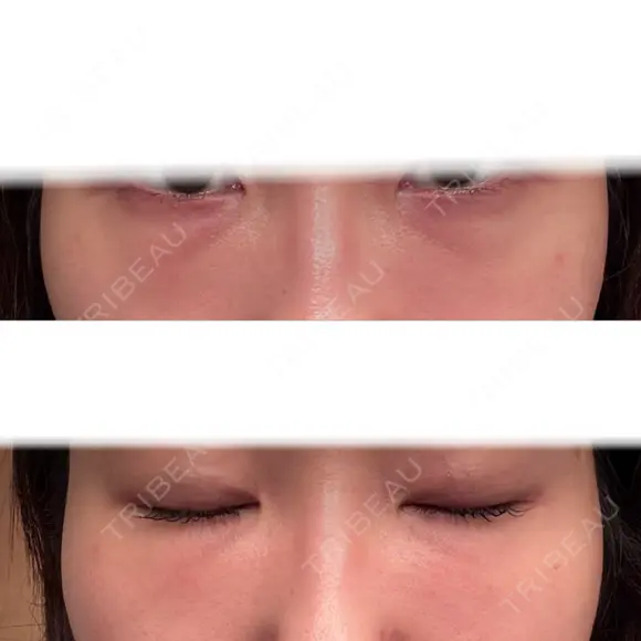 脂肪注入（目の下） 大塚美容形成外科 京都院 DAY 49 メイン用