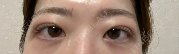 二重埋没 湘南美容クリニック 千葉センシティ院 DAY 2 メイン用