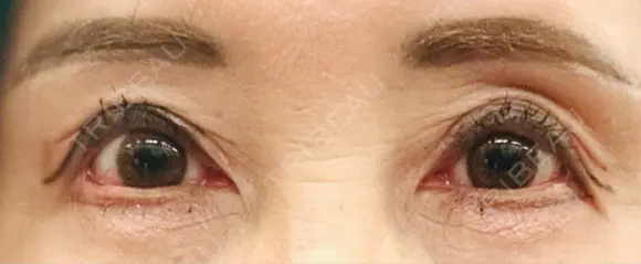 二重切開 / 眼瞼下垂（切開） / 上まぶたたるみ取り / 眉下切開 / 脂肪吸引注射（顔） / 肌ヒアルロン酸注入（たるみ・シワ改善） 東京シンデレラ美容外科 新宿院 DAY 119 メイン用