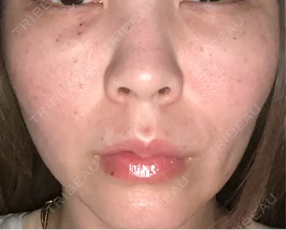 ヒアルロン酸注入（唇） / ボトックス（口角） / スネコス / ポテンツァ ルラ美容クリニック 札幌本院 DAY 0 メイン用