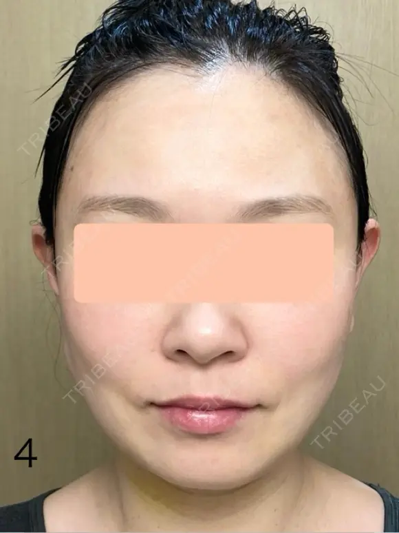 糸リフト / 脂肪吸引（顔） 脂肪吸引ラボトウキョウ DAY 4 メイン用
