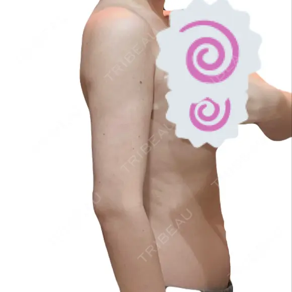 糸リフト / 脂肪吸引（顔） / 脂肪吸引（二の腕） / ワキ汗治療（切開） / 脂肪吸引注射（顔） ICON CLINIC DAY 24 メイン用