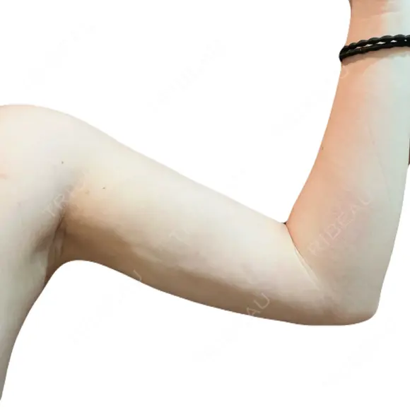 糸リフト / 脂肪吸引（顔） / 脂肪吸引（二の腕） / ワキ汗治療（切開） / 脂肪吸引注射（顔） ICON CLINIC DAY 24 メイン用