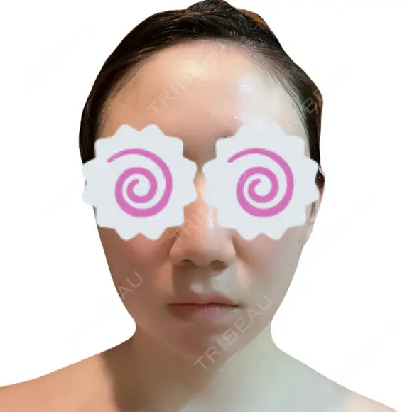 糸リフト / 脂肪吸引（顔） / 脂肪吸引（二の腕） / ワキ汗治療（切開） / 脂肪吸引注射（顔） ICON CLINIC DAY 24 メイン用