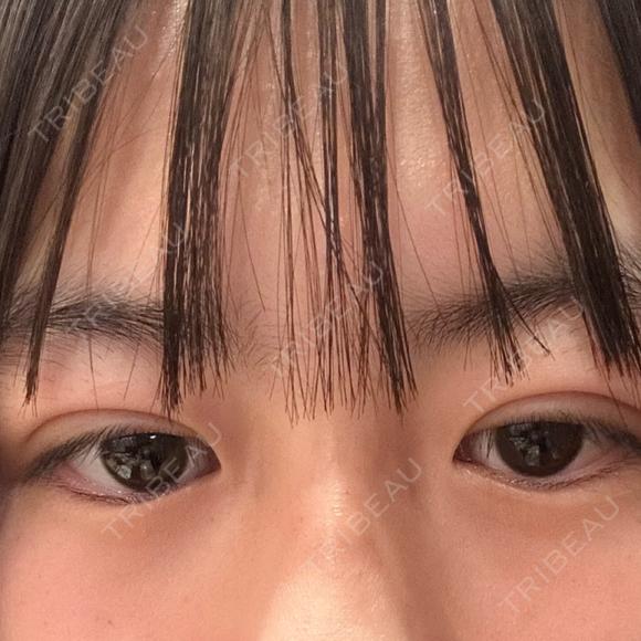 二重埋没 湘南美容クリニック 千葉センシティ院 DAY 2 メイン用