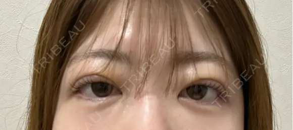 二重埋没 湘南美容クリニック 千葉センシティ院 DAY 3 メイン用