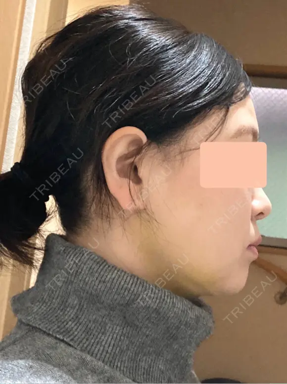 糸リフト / 脂肪吸引（顔） 脂肪吸引ラボトウキョウ DAY 7 メイン用