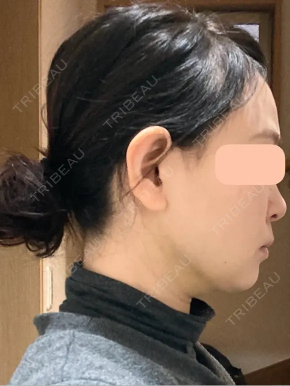 糸リフト / 脂肪吸引（顔） 脂肪吸引ラボトウキョウ DAY 11 メイン用