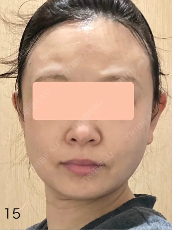 糸リフト / 脂肪吸引（顔） 脂肪吸引ラボトウキョウ DAY 15 メイン用