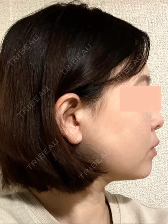 糸リフト / 脂肪吸引（顔） 脂肪吸引ラボトウキョウ DAY 26 メイン用