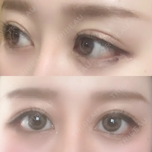 目尻切開 / 目尻靭帯移動 FROM B整形外科 (旧バウム整形外科) DAY 25 メイン用