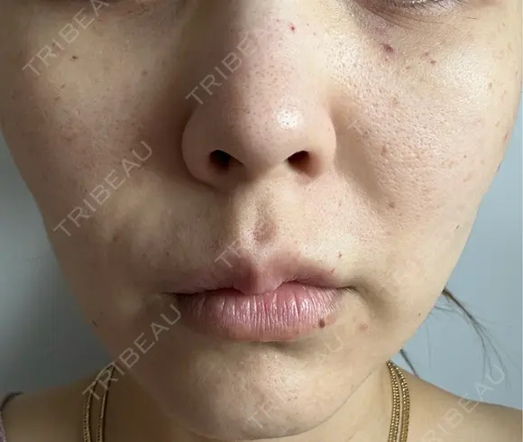 ヒアルロン酸注入（唇） / ボトックス（口角） / スネコス / ポテンツァ ルラ美容クリニック 札幌本院 DAY 2 メイン用