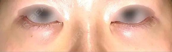 下まぶたの脂肪取り APOLLO BEAUTY CLINIC AFTER メイン用