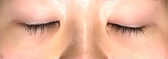 下まぶたの脂肪取り APOLLO BEAUTY CLINIC DAY 15 メイン用