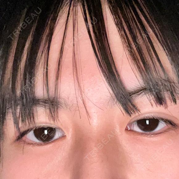 二重埋没 湘南美容クリニック 千葉センシティ院 DAY 4 メイン用