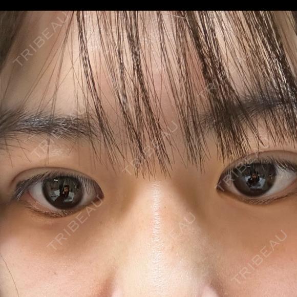 二重埋没 湘南美容クリニック 千葉センシティ院 DAY 3 メイン用