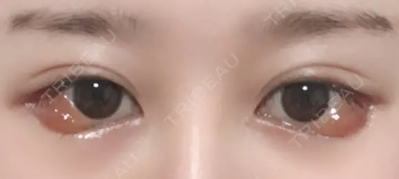 目尻切開 / 目尻靭帯移動 FROM B整形外科 (旧バウム整形外科) DAY 7 メイン用