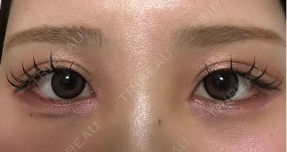 二重切開 / 目頭切開 オーキッド美容クリニック東京御徒町 DAY 135 メイン用