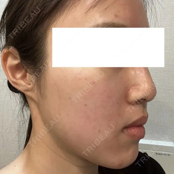 ルビーレーザー 日本美容・医療クリニック 六本木院 AFTER メイン用