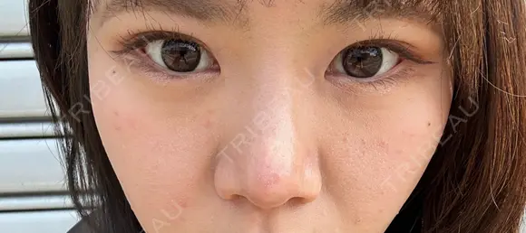 二重埋没 / 隆鼻術 / 鼻尖形成（切開） / 小鼻縮小（切開） / 軟骨移植 R Beauty CLINIC 名古屋院 DAY 154 メイン用