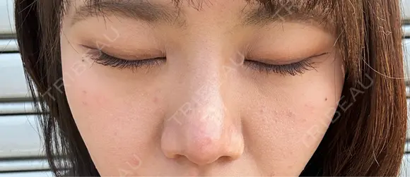 二重埋没 / 隆鼻術 / 鼻尖形成（切開） / 小鼻縮小（切開） / 軟骨移植 R Beauty CLINIC 名古屋院 DAY 154 メイン用