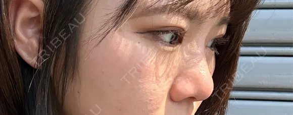 二重埋没 / 隆鼻術 / 鼻尖形成（切開） / 小鼻縮小（切開） / 軟骨移植 R Beauty CLINIC 名古屋院 DAY 154 メイン用