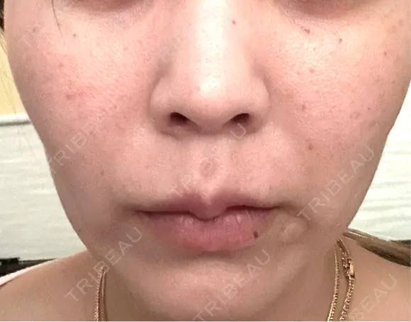 ヒアルロン酸注入（唇） / ボトックス（口角） / スネコス / ポテンツァ ルラ美容クリニック 札幌本院 AFTER メイン用